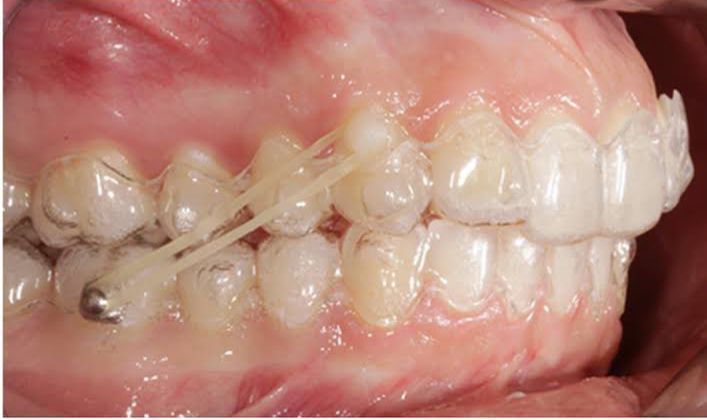 Inter Maxillary Elastics with TAD Anchorage